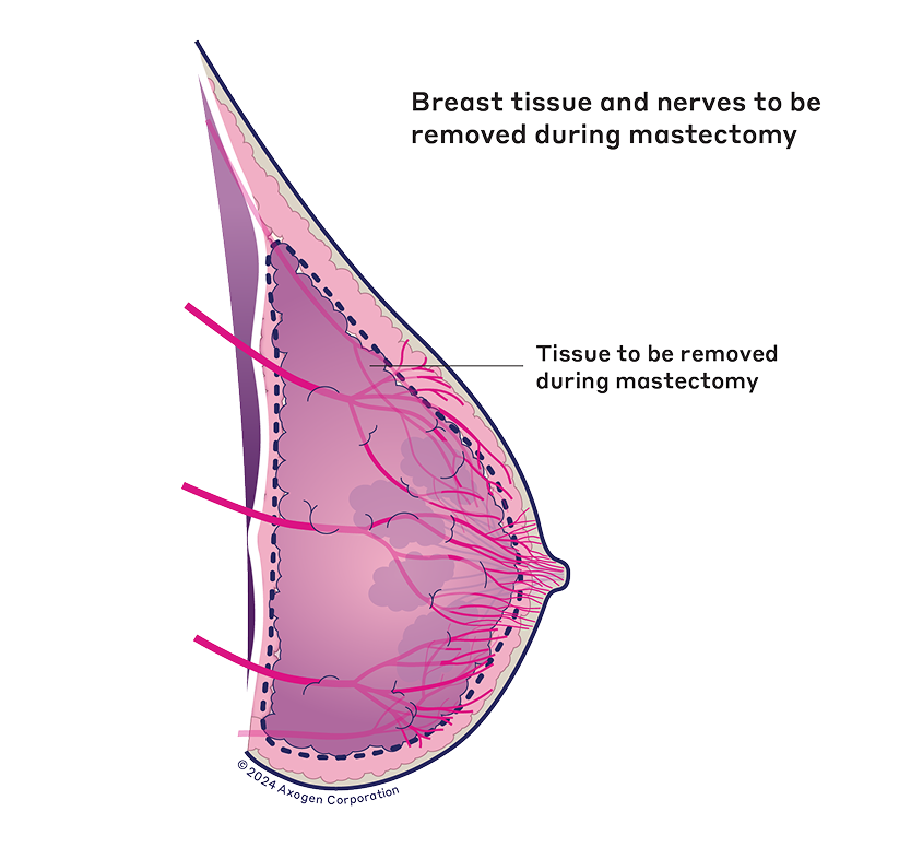 Breast tissue and nerves to be removed during nipple-sparing mastectomy