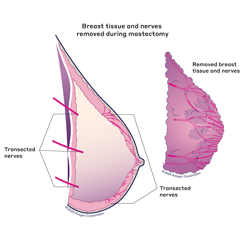 Breast tissue and nerves removed during nipple-sparing mastectomy