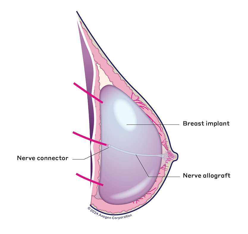 Breast implant with nerve allograft