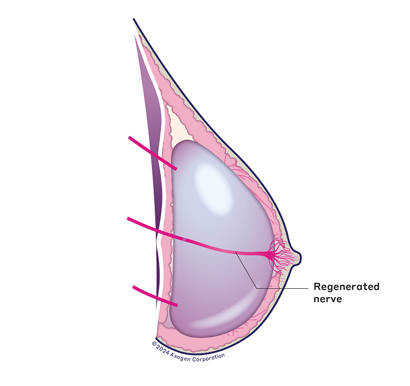 Breast implant with regenerated nerve